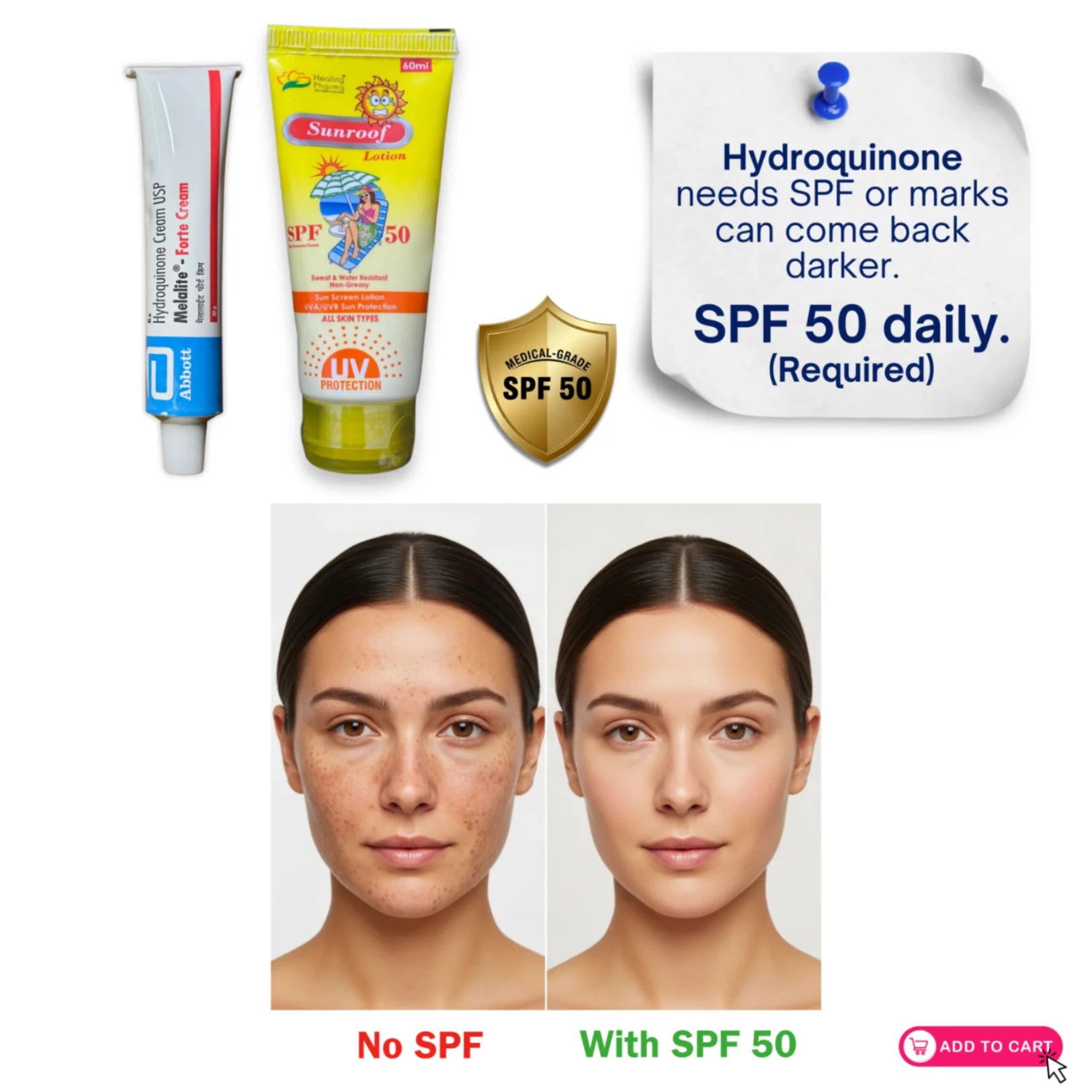 Hydroquinone cream pigmentation treatment comparison with SPF 50 versus no sunscreen