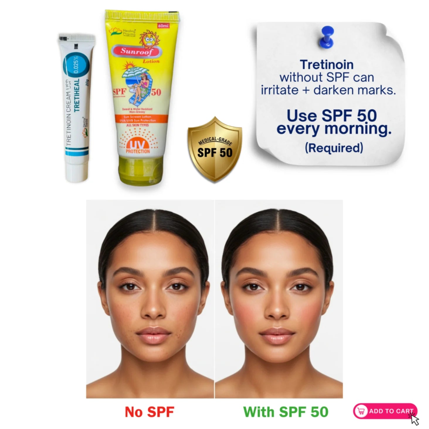 Comparison showing tretinoin 0.025% skincare results with SPF 50 sunscreen and without SPF