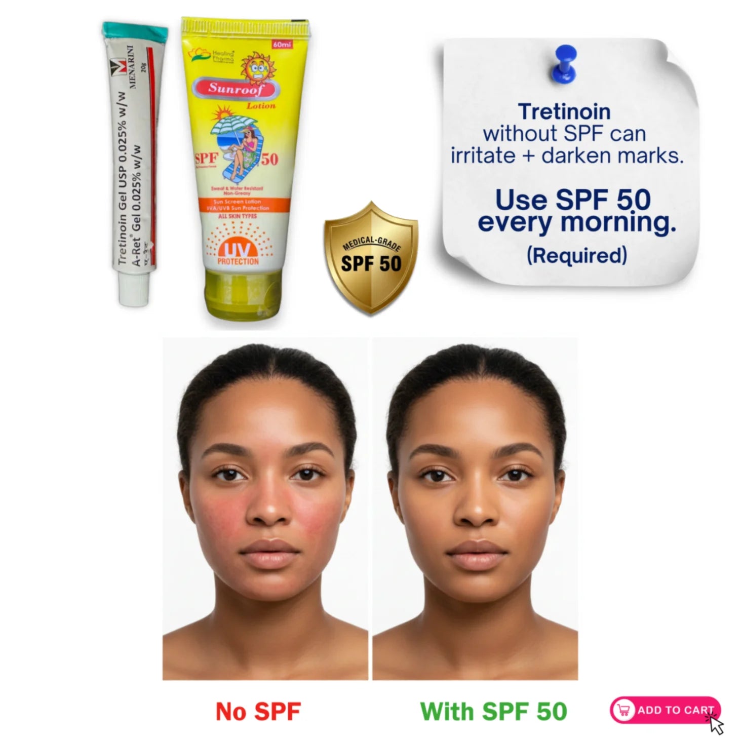 Comparison showing tretinoin gel 0.025% skincare results with SPF 50 sunscreen and without SPF