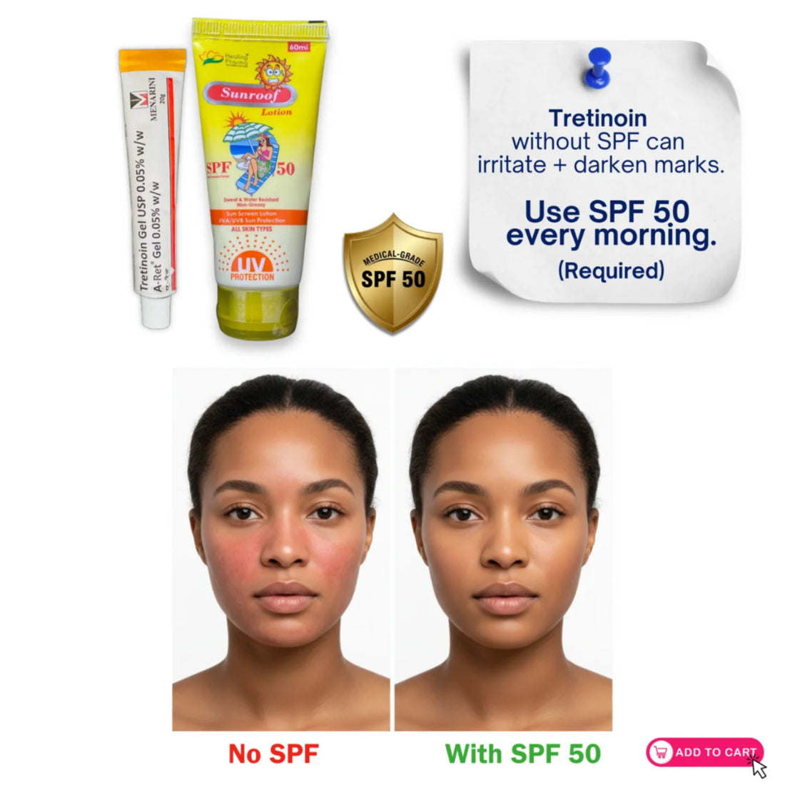Tretinoin gel 0.05% skincare routine comparison with SPF 50 versus no sunscreen