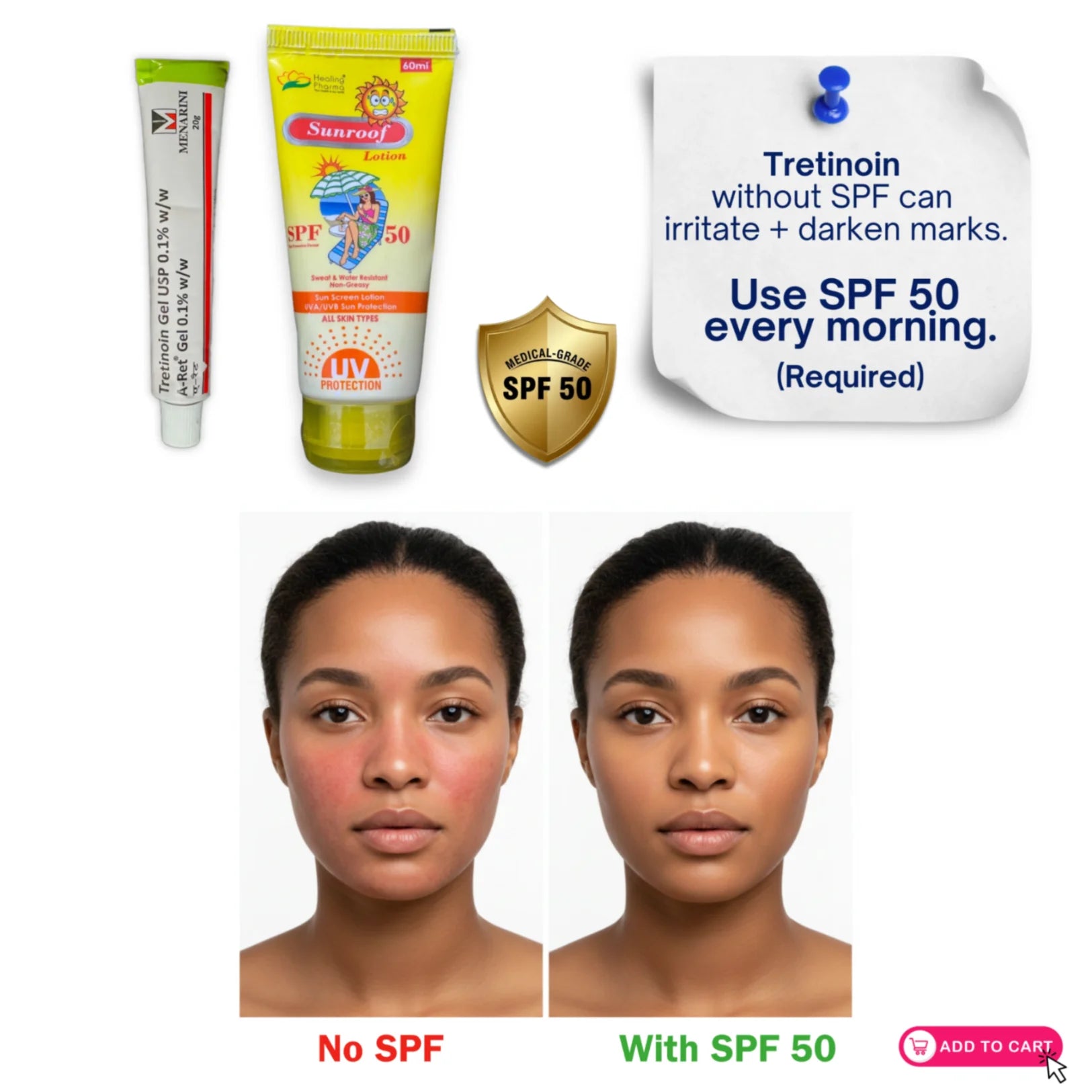 Tretinoin gel 0.1% skincare routine comparison with SPF 50 versus no sunscreen